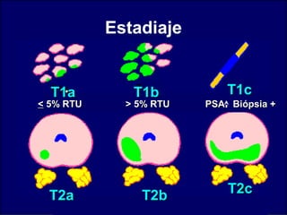 T1aT1a T1bT1b T1cT1c
<< 5% RTU5% RTU > 5% RTU> 5% RTU PSA Biópsia +PSA Biópsia +
T2cT2c
T2aT2a T2bT2b
Estadiaje
 
