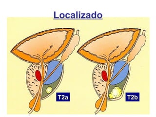 T2aT2a T2bT2b
Localizado
 