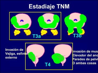 T3aT3a
Invasión deInvasión de
Vejiga, esfinterVejiga, esfinter
externoexterno
Invasión de musInvasión de musc
Elevador del anoElevador del ano
Paredes de pelviParedes de pelvi
O ambas cosasO ambas cosas
T3bT3b
T4T4
Estadiaje TNM
 