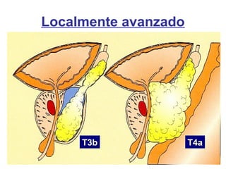 T4aT4aT3bT3b
Localmente avanzado
 