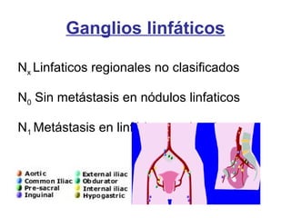 Nx Linfaticos regionales no clasificados
N0 Sin metástasis en nódulos linfaticos
N1 Metástasis en linfáticos regionales
Ganglios linfáticos
 