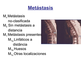 Mx Metástasis
no-clasificada
M0 Sin metástasis a
distancia
M1 Metástasis presentes
M1a Linfáticos a
distância
M1b Huesos
M1c Otras localizaciones
Metástasis
 