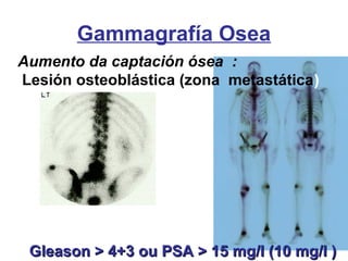 Gammagrafía Osea
Aumento da captación ósea :
Lesión osteoblástica (zona metastática)
Gleason > 4+3 ou PSA > 15 mg/l (10 mg/l )Gleason > 4+3 ou PSA > 15 mg/l (10 mg/l )
 