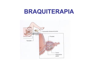 BRAQUITERAPIA
 