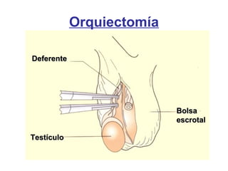 DeferenteDeferente
TestículoTestículo
BolsaBolsa
escrotalescrotal
Orquiectomía
 
