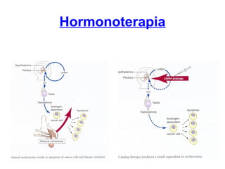 Hormonoterapia
 