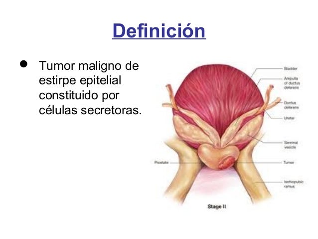 Cancer De Prostata Cancer De Prostata