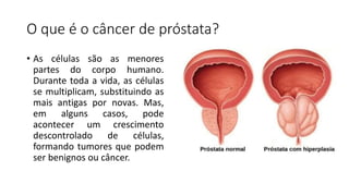 O que é o câncer de próstata?
• As células são as menores
partes do corpo humano.
Durante toda a vida, as células
se multiplicam, substituindo as
mais antigas por novas. Mas,
em alguns casos, pode
acontecer um crescimento
descontrolado de células,
formando tumores que podem
ser benignos ou câncer.
 