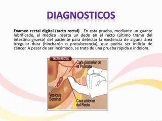Examen rectal digital (tacto rectal) . En esta prueba, mediante un guante
lubrificado, el médico inserta un dedo en el recto (último tramo del
intestino grueso) del paciente para detectar la existencia de alguna área
irregular dura (hinchazón o protuberancia), que podría ser indicio de
cáncer. A pesar de ser incómoda, se trata de una prueba rápida e indolora.
 