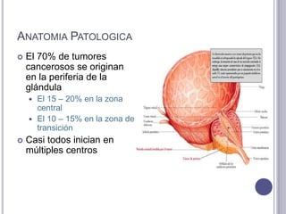 ANATOMIA PATOLOGICA
 El 70% de tumores
cancerosos se originan
en la periferia de la
glándula
 El 15 – 20% en la zona
central
 El 10 – 15% en la zona de
transición
 Casi todos inician en
múltiples centros
 