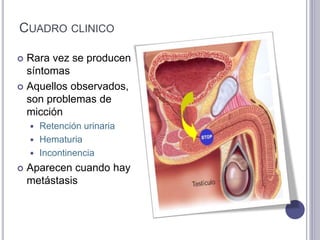 CUADRO CLINICO
 Rara vez se producen
síntomas
 Aquellos observados,
son problemas de
micción
 Retención urinaria
 Hematuria
 Incontinencia
 Aparecen cuando hay
metástasis
 