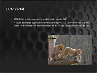 Tacto rectal 50% de las lesiones sospechosas terminan siendo CaP A causa del riesgo significativo de cancer de próstata, se recomienda la BP en todos los hombres con anormalidades en el TR, sea cual fuera el nivel de PSA. 