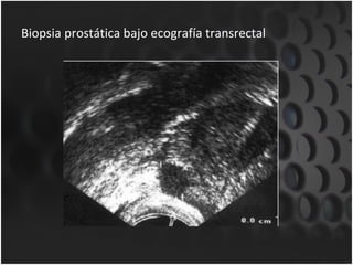 Biopsia prostática bajo ecografía transrectal 