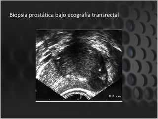 Biopsia prostática bajo ecografía transrectal 