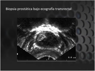 Biopsia prostática bajo ecografía transrectal 