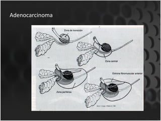 Adenocarcinoma 
