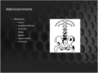 Adenocarcinoma Metástasis Hueso Ganglios linfáticos Pulmones Vejiga Hígado Suprarrenales Testiculos 