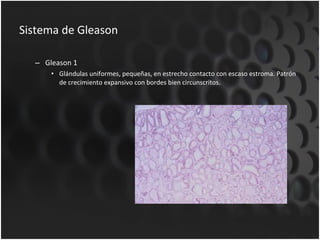 Sistema de Gleason Gleason 1 Glándulas uniformes, pequeñas, en estrecho contacto con escaso estroma. Patrón de crecimiento expansivo con bordes bien circunscritos. 