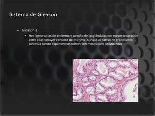Sistema de Gleason Gleason 2 Hay ligera variación en forma y tamaño de las glándulas con mayor separación entre ellas y mayor cantidad de estroma. Aunque el patrón de crecimiento continua siendo expansivo los bordes son menos bien circunscritos .  
