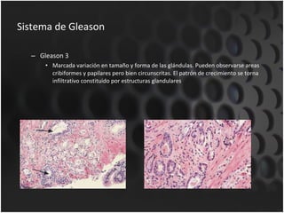 Sistema de Gleason Gleason 3 Marcada variación en tamaño y forma de las glándulas. Pueden observarse areas cribiformes y papilares pero bien circunscritas. El patrón de crecimiento se torna infiltrativo constituido por estructuras glandulares . 