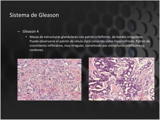 Sistema de Gleason Gleason 4 Masas de estructuras glandulares con patrón cribiforme, de bordes irregulares. Puede observarse el patrón de célula clara conocido como hipernefroide. Patrón de crecimiento infiltrativo, muy irregular, constituido por estructuras cribiformes o cordones. 