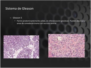 Sistema de Gleason Gleason 5 Patrón predominantemente sólido, sin diferenciación glandular. Pueden observarse areas de comedocarcinoma con necrosis central. 