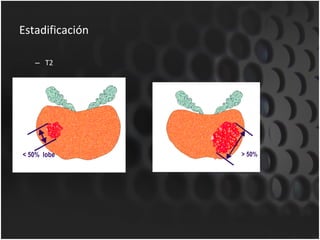 Estadificación T2 