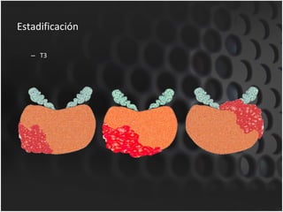 Estadificación T3 