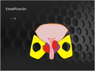Estadificación T4 
