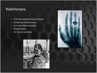 Radioterapia. Con haz externo convencional. Conformal tridimencional. Con intensidad modulada Braquiterapia Con haz de protones 