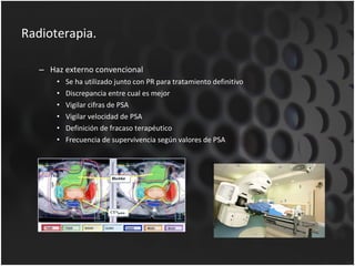 Radioterapia. Haz externo convencional Se ha utilizado junto con PR para tratamiento definitivo Discrepancia entre cual es mejor Vigilar cifras de PSA Vigilar velocidad de PSA Definición de fracaso terapéutico Frecuencia de supervivencia según valores de PSA 