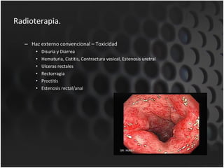 Radioterapia. Haz externo convencional – Toxicidad Disuria y Diarrea Hematuria, Cistitis, Contractura vesical, Estenosis uretral Ulceras rectales Rectorragia Proctitis Estenosis rectal/anal 