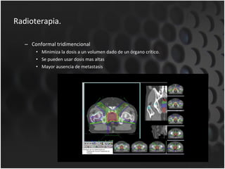 Radioterapia. Conformal tridimencional Minimiza la dosis a un volumen dado de un órgano crítico. Se pueden usar dosis mas altas Mayor ausencia de metastasis 