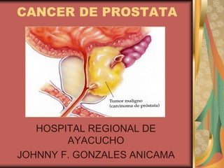 CANCER DE PROSTATA




   HOSPITAL REGIONAL DE
        AYACUCHO
JOHNNY F. GONZALES ANICAMA
 