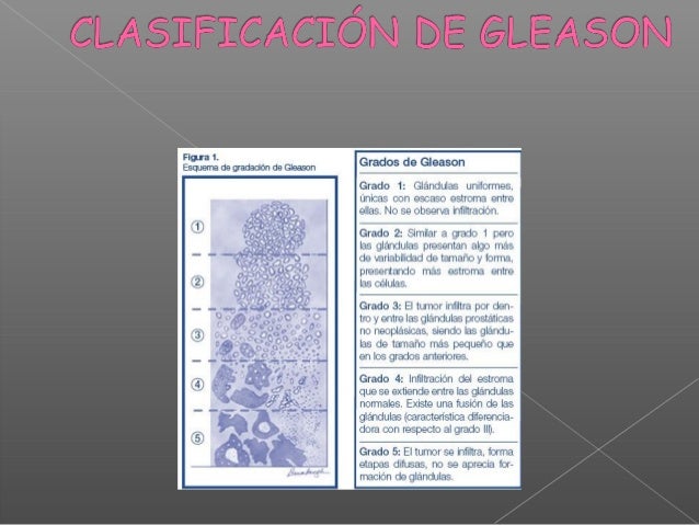 Cancer De Prostata Yanina