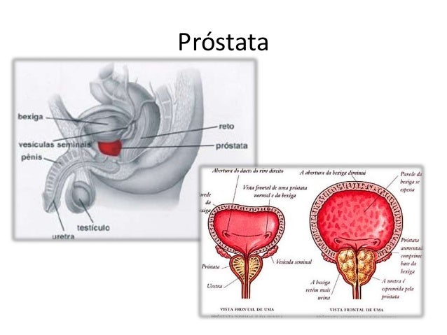 Se puede quitar la prostata