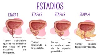 Tumor subclínico
que no es evidente
por tacto ni por
estudios de
imágenes.
Tumor
limitando a
la próstata.
Tumor se
extiende a través
de la cápsula
prostática.
Tumor invade
tejido subyacente.
ESTADIOS
ETAPA 1 ETAPA 2 ETAPA 3 ETAPA 4
 