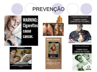 PREVENÇÃO
 