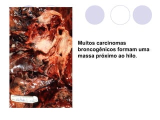 Muitos carcinomas
broncogênicos formam uma
massa próximo ao hilo.
 