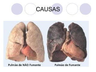 CAUSAS
 