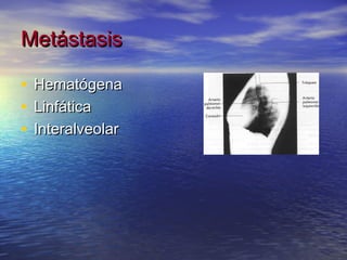 Metástasis

•   Hematógena
•   Linfática
•   Interalveolar
 