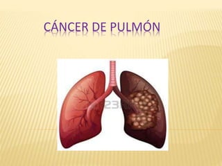 CÁNCER DE PULMÓN
 