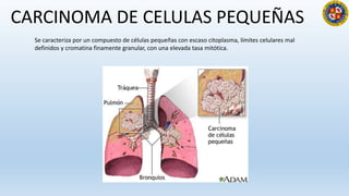 CARCINOMA DE CELULAS PEQUEÑAS
Se caracteriza por un compuesto de células pequeñas con escaso citoplasma, límites celula...