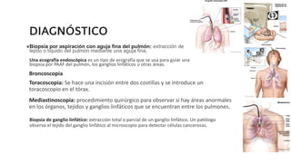 DIAGNÓSTICO
●Biopsia por aspiración con aguja fina del pulmón: extracción de
tejido o líquido del pulmón mediante una aguja fina.
Una ecografía endoscópica es un tipo de ecografía que se usa para guiar una
biopsia por PAAF del pulmón, los ganglios linfáticos u otras áreas.
Broncoscopia
Toracoscopia: Se hace una incisión entre dos costillas y se introduce un
toracoscopio en el tórax.
Mediastinoscopia: procedimiento quirúrgico para observar si hay áreas anormales
en los órganos, tejidos y ganglios linfáticos que se encuentran entre los pulmones.
Biopsia de ganglio linfático: extracción total o parcial de un ganglio linfático. Un patólogo
observa el tejido del ganglio linfático al microscopio para detectar células cancerosas.
 