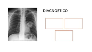 DIAGNÓSTICO
Examen físico y
antecedentes
de salud
Pruebas de
laboratorio:
Radiografía del
TÓRAX
 
