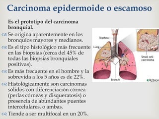 Carcinoma epidermoide o escamoso
Es el prototipo del carcinoma
bronquial.
 Se origina aparentemente en los
bronquios mayores y medianos.
 Es el tipo histológico más frecuente
en las biopsias (cerca del 45% de
todas las biopsias bronquiales
positivas).
 Es más frecuente en el hombre y la
sobrevida a los 5 años es de 22%.
 Histológicamente son carcinomas
sólidos con diferenciación córnea
(perlas córneas y disqueratosis) o
presencia de abundantes puentes
intercelulares, o ambas.
 Tiende a ser multifocal en un 20%.
 