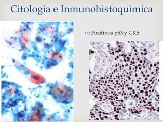 Citologia e Inmunohistoquimica
 Positivos p63 y CK5
 