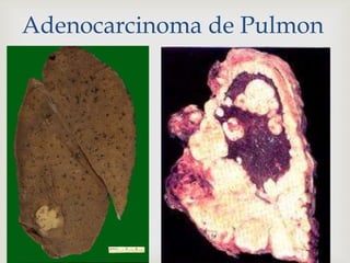 Adenocarcinoma de Pulmon
 