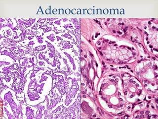 Adenocarcinoma
 