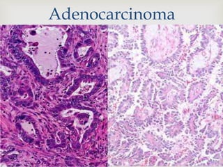 Adenocarcinoma
 